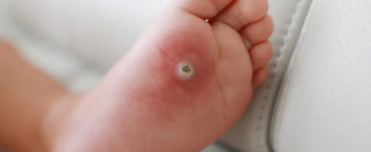 Närbild på en fot med en tydlig vårta under foten. Huden runt vårtan är lite röd.