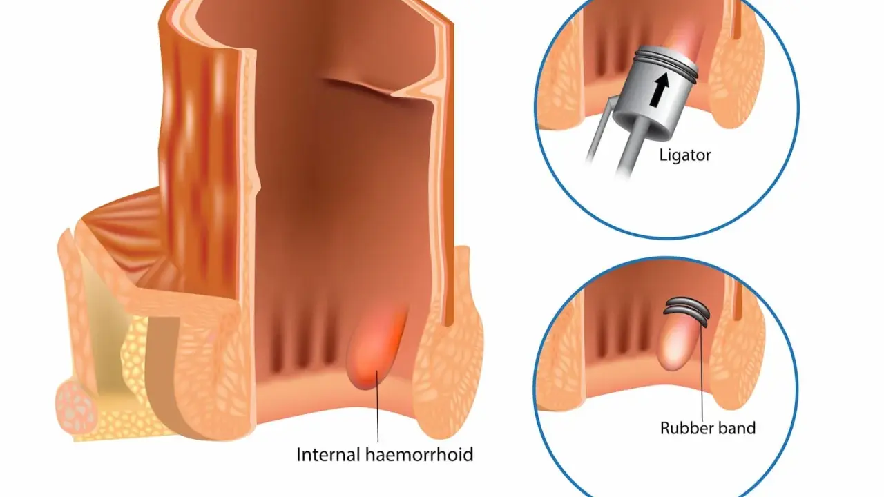 Illustration visar hur man kan ta bort hemorrojder med en gummibandsligering. Ett instrument placerar ett band runt hemorrojden.