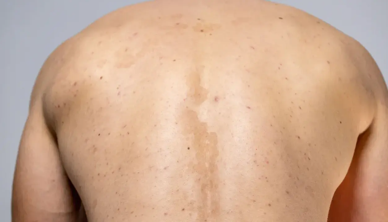 Rygg med fläckar och utslag, troligen pityriasis versicolor.