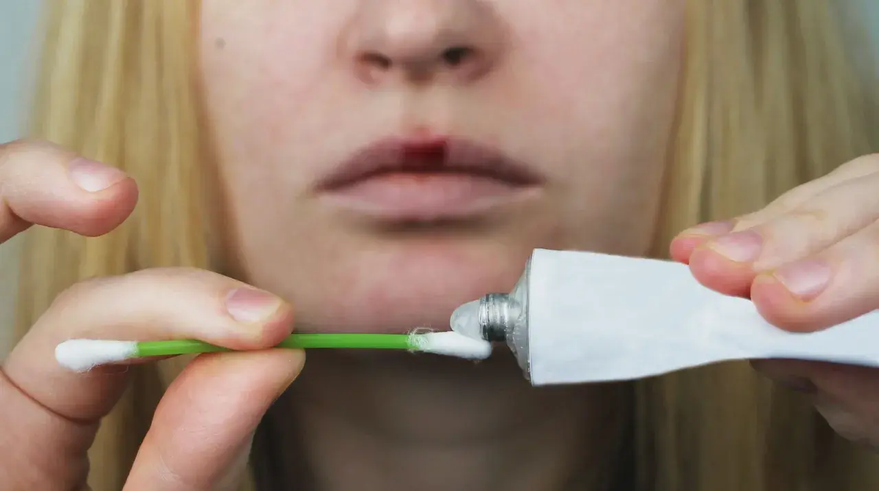 Person applicerar salva på ett sår på läppen, liknande hur man behandlar herpes i underlivet.