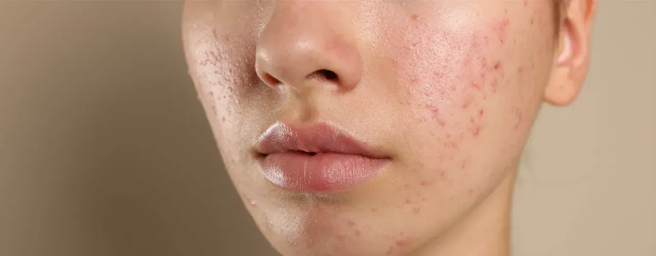 Närbild på en tonårings ansikte med synlig acne. Huden är rödflammig och har flera finnar och pormaskar.