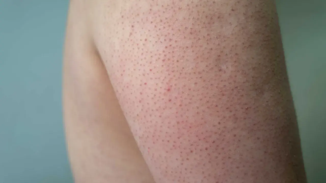 När huden på armarna blir kall kan den likna kycklinghud med små röda prickar.