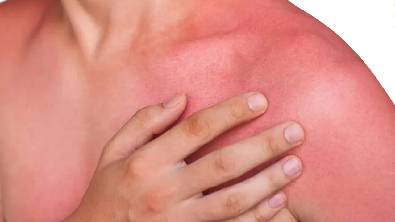En person med kraftigt solbränd, röd hud på axlar och bröst. Huden ser ut att ha feber efter för mycket sol.