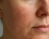 Närbild på en persons ansikte med extrem torr hud som flagnar och är rödflammig.