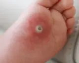 Närbild på en fot med en tydlig vårta under foten. Huden runt vårtan är lite röd.