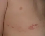 Barnets hud visar knottrig hud med röda utslag, troligen bältros.