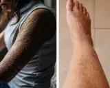 Bilden visar en person med svårt torr hud på armen och ett ben. Huden är fjällande och sprucken, vilket indikerar extrem torrhet.