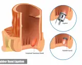 Illustration visar hur man kan ta bort hemorrojder med en gummibandsligering. Ett instrument placerar ett band runt hemorrojden.
