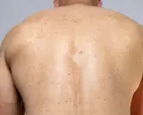 Rygg med fläckar och utslag, troligen pityriasis versicolor.