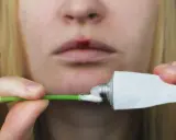 Person applicerar salva på ett sår på läppen, liknande hur man behandlar herpes i underlivet.