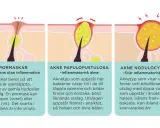 Illustrationer visar hur man vet om man har akne: pormaskar, inflammatorisk akne och svår inflammatorisk akne.