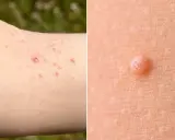 Närbild på hud med mollusker, en hudåkomma som kan kräva mollusker behandling. Enskilda utslag visas tydligt.