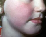 Barnets ansikte är rött och knottrigt, vilket tyder på en allergisk reaktion.