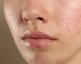 Närbild på en tonårings ansikte med synlig acne. Huden är rödflammig och har flera finnar och pormaskar.