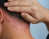 Nära bild på en persons nacke och öra med rodnad och fjällande hud som indikerar mild psoriasis.