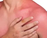 En person med kraftigt solbränd, röd hud på axlar och bröst. Huden ser ut att ha feber efter för mycket sol.