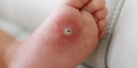 Närbild på en fot med en tydlig vårta under foten. Huden runt vårtan är lite röd.