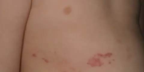 Barnets hud visar knottrig hud med röda utslag, troligen bältros.