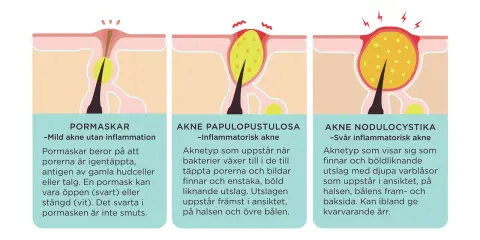 Illustrationer visar hur man vet om man har akne: pormaskar, inflammatorisk akne och svår inflammatorisk akne.