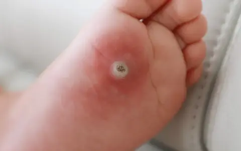 Närbild på en fot med en tydlig vårta under foten. Huden runt vårtan är lite röd.