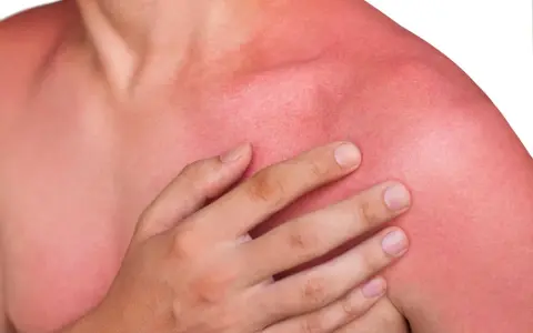 En person med kraftigt solbränd, röd hud på axlar och bröst. Huden ser ut att ha feber efter för mycket sol.