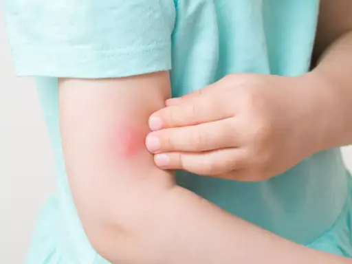 Ett barn kliar sig på armen där ett rött, svullet myggbett syns. Barnet verkar vara allergisk mot myggbett.