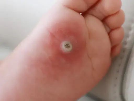 Närbild på en fot med en tydlig vårta under foten. Huden runt vårtan är lite röd.