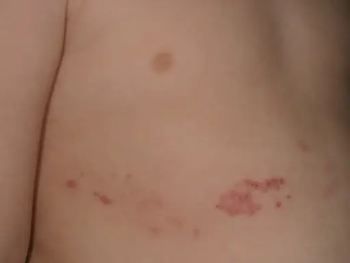 Barnets hud visar knottrig hud med röda utslag, troligen bältros.