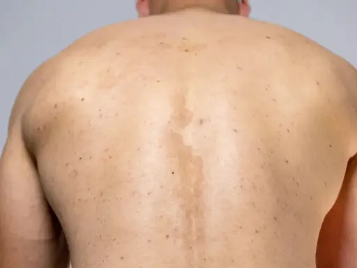 Rygg med fläckar och utslag, troligen pityriasis versicolor.
