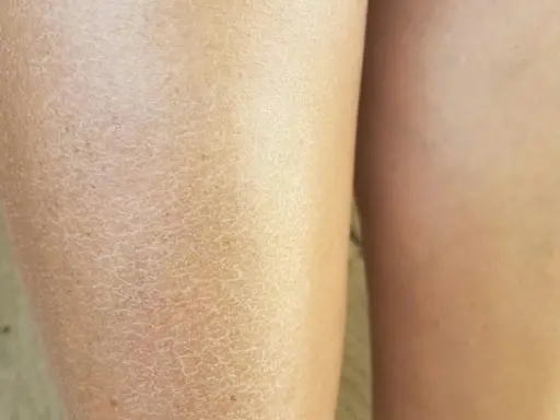 Tänk om huden blir torr och spröd under klimakteriet? Här syns en närbild på torr hud med ett nätliknande mönster.