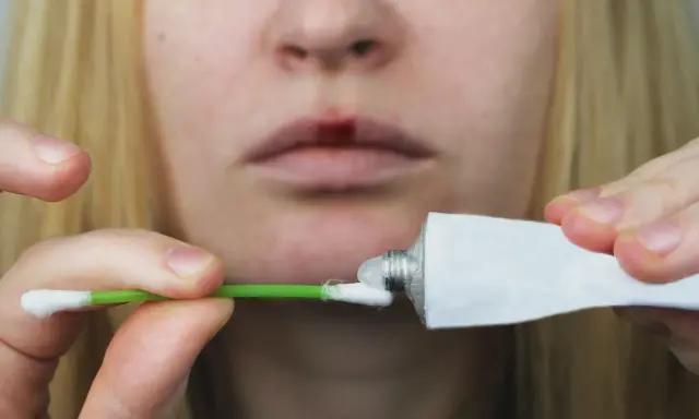 Person applicerar salva på ett sår på läppen, liknande hur man behandlar herpes i underlivet.