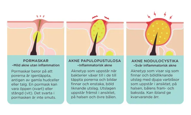 Illustrationer visar hur man vet om man har akne: pormaskar, inflammatorisk akne och svår inflammatorisk akne.