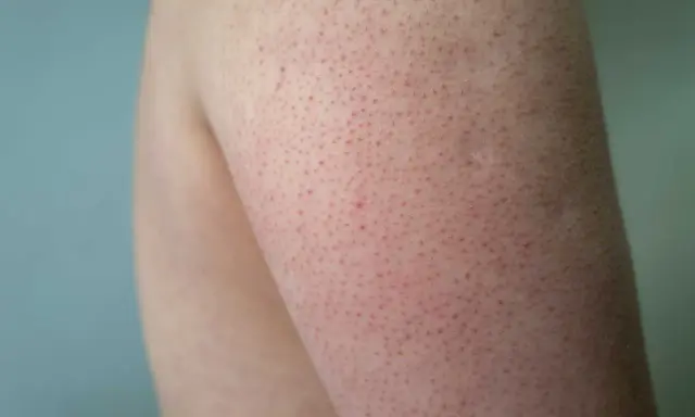 När huden på armarna blir kall kan den likna kycklinghud med små röda prickar.