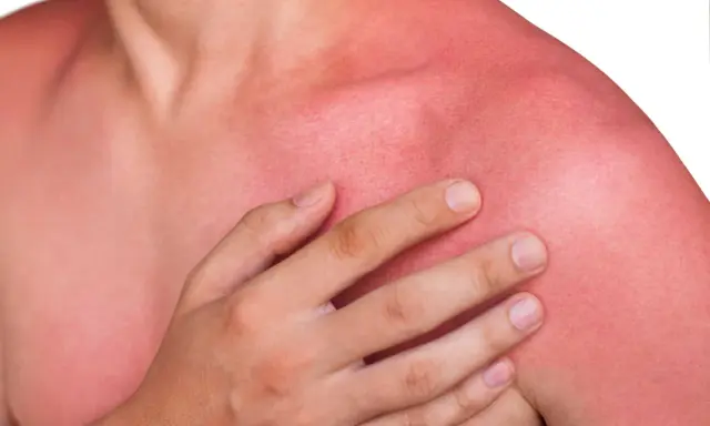 En person med kraftigt solbränd, röd hud på axlar och bröst. Huden ser ut att ha feber efter för mycket sol.