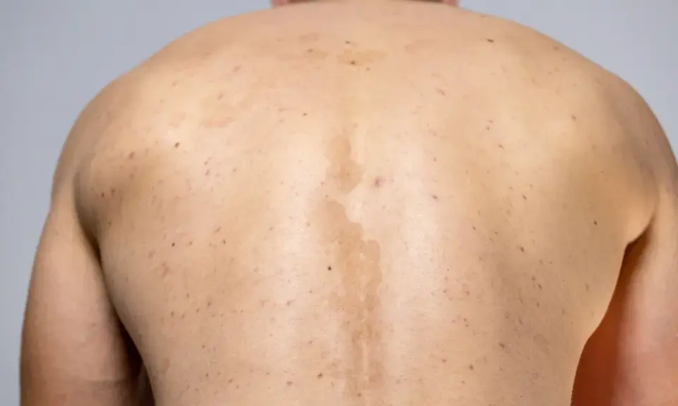 Rygg med fläckar och utslag, troligen pityriasis versicolor.