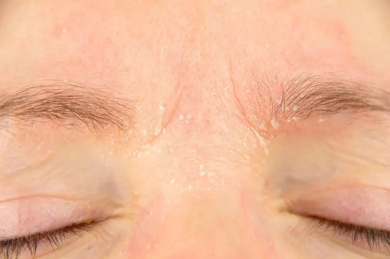 Hud som flagnar och &auml;r r&ouml;d runt &ouml;gonbrynen, m&ouml;jligtvis retinol biverkningar.