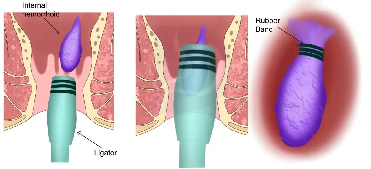 Illustration visar hur man kan ta bort hemorrojder med ett ligatorinstrument och gummiband.