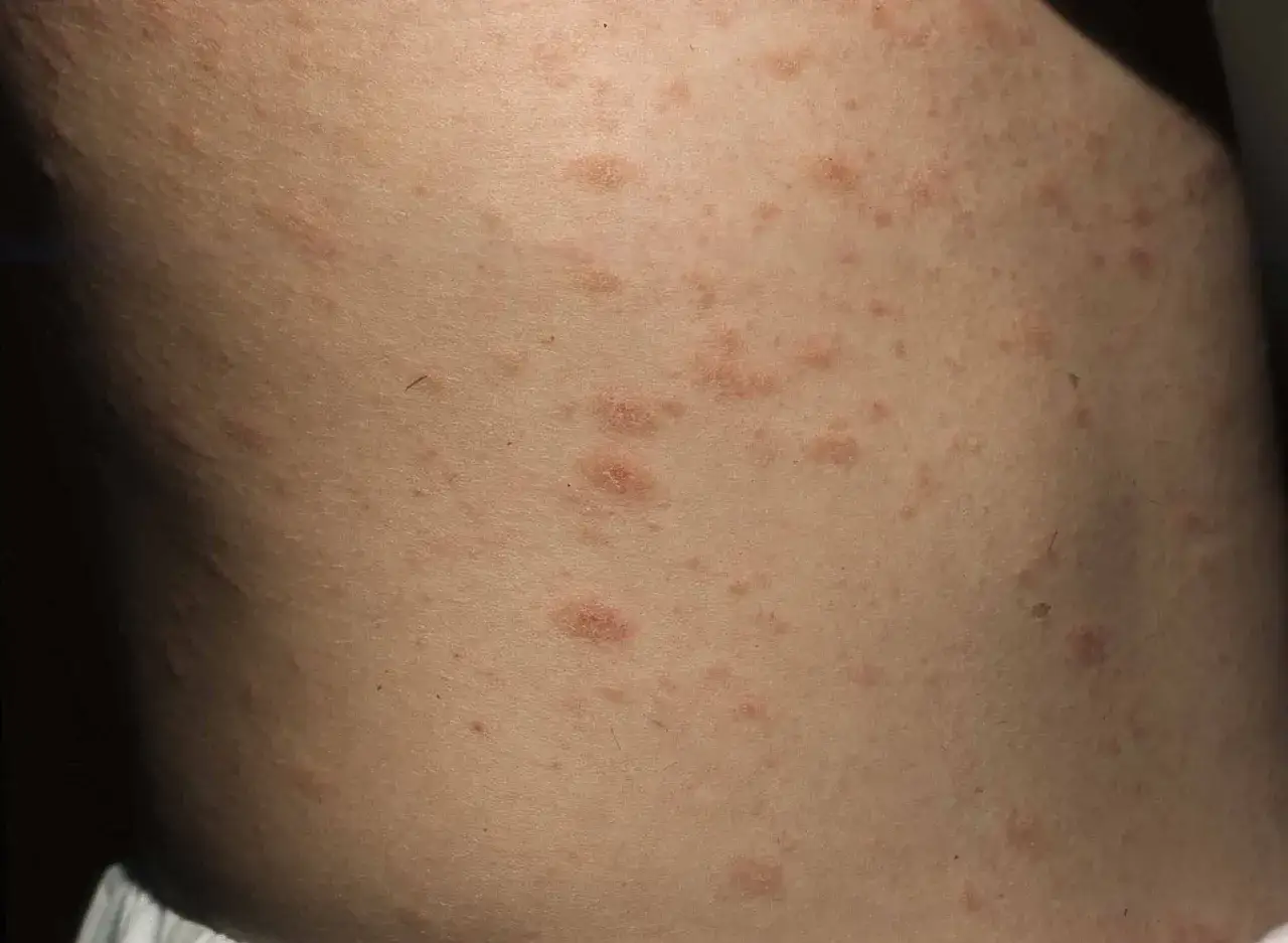 Hud med utslag som tyder p&aring; mild psoriasis. R&ouml;da, sm&aring; fl&auml;ckar sprider sig &ouml;ver huden.