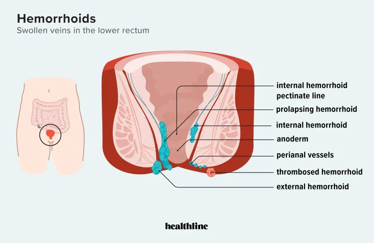 Illustration visar hur man vet om man har hemorrojder, med interna och externa svullna vener i ändtarmen.