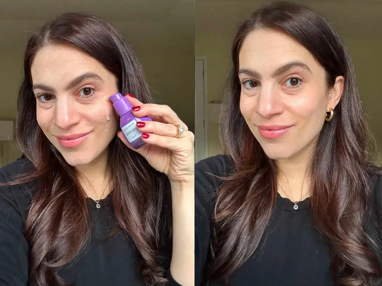 Kvinna applicerar serum med retinol mot akne. Huden ser klarare ut efter anv&auml;ndning.