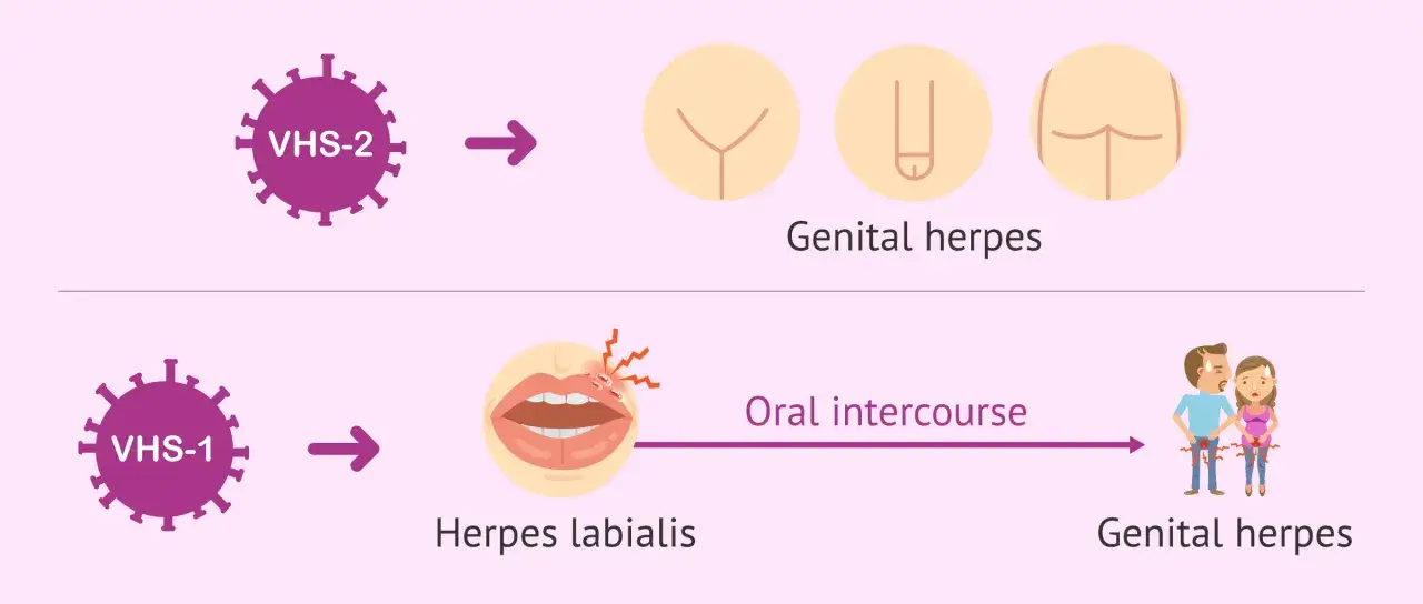 VHS-2 orsakar herpes i underlivet. VHS-1 kan ge munsår, men även herpes i underlivet efter oralsex.