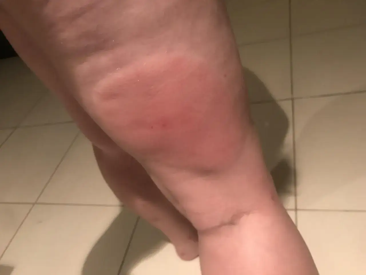 En stor, r&ouml;d och svullen fl&auml;ck p&aring; ett ben, troligen ett tecken p&aring; att personen &auml;r allergisk mot myggbett.