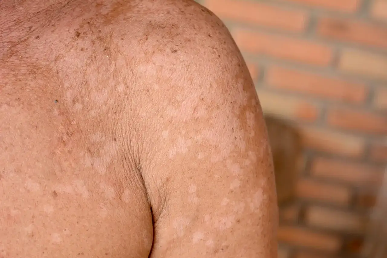 Hud med fläckar orsakade av pityriasis versicolor.