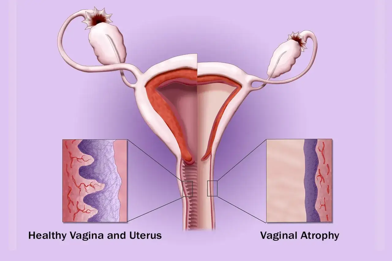 Illustration visar livmoder och äggstockar, med närbilder på frisk och atrofisk vagina. Atrofi kan orsaka ont vid samlag klimakteriet.