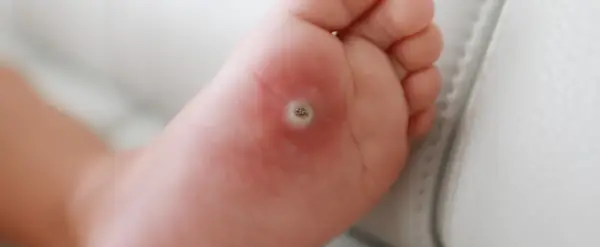 Närbild på en fot med en tydlig vårta under foten. Huden runt vårtan är lite röd.