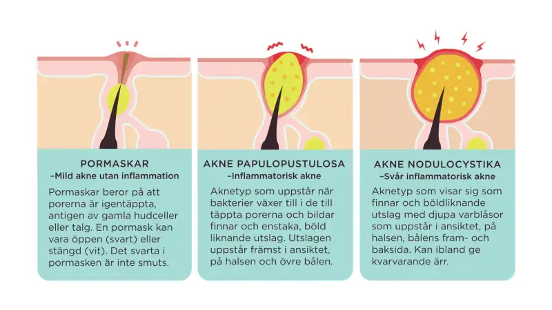 Illustrationer visar hur man vet om man har akne: pormaskar, inflammatorisk akne och svår inflammatorisk akne.